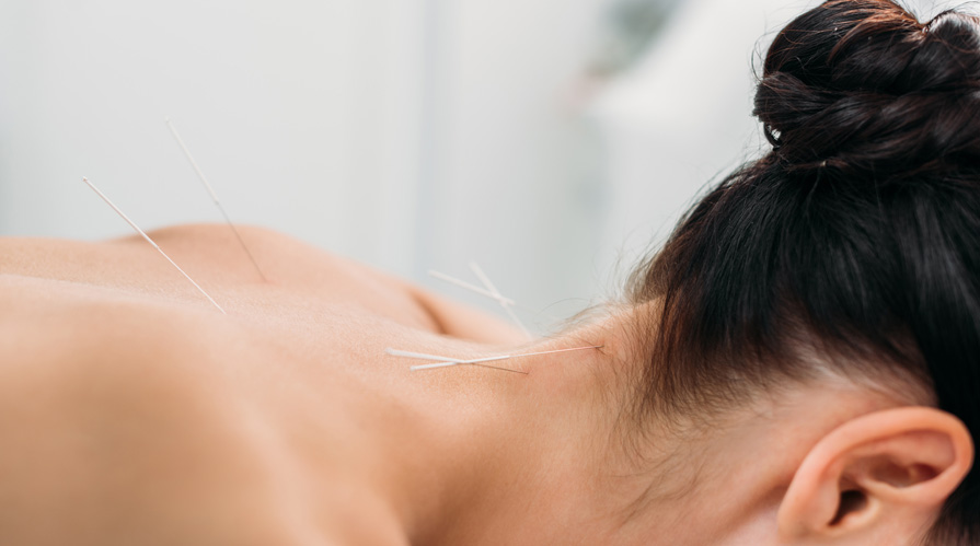 Woman Getting Acupuncture